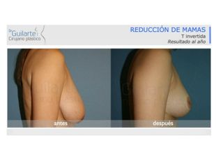 Antes y después Reducción de senos