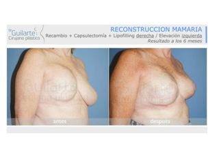 Antes y después Reconstrucción de mama