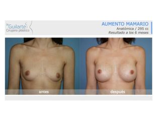 Antes y después Aumento de pecho