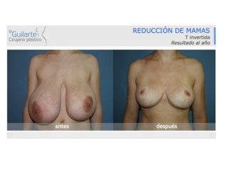 foto-pecho-drguilarte-caso-real-de-reduccion-senos-id010