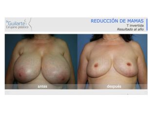 Antes y después Reducción de senos
