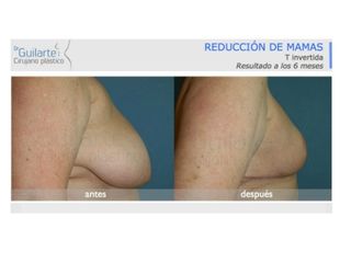 Antes y después Reducción de senos