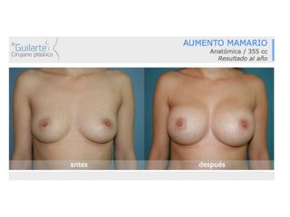 Antes y después Aumento de pecho