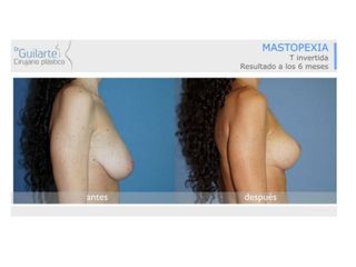 Antes y después Mastopexia 