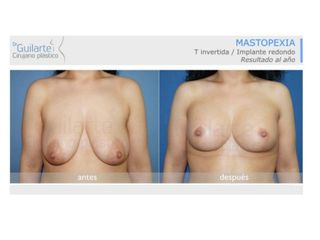 Antes y después Mastopexia 