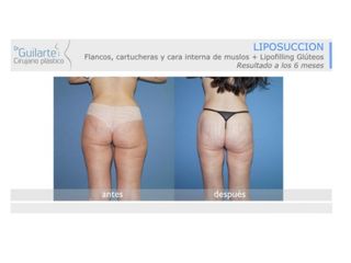 Antes y después Liposucción