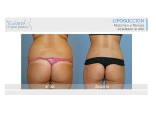 Antes y después Liposucción