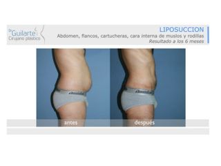 Antes y después Liposucción
