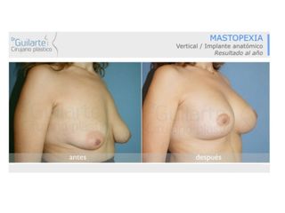 Antes y después Mastopexia 