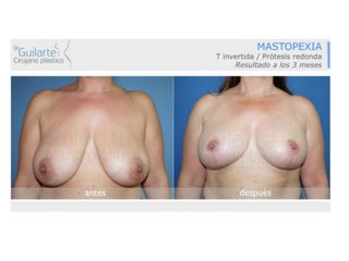 Antes y después Mastopexia 