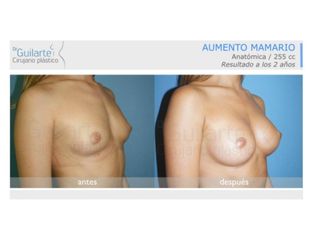 Antes y después Aumento de pecho