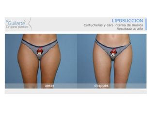 Antes y después Liposucción