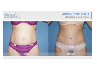 Antes y después Abdominoplastia