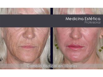 Peeling - 650148
