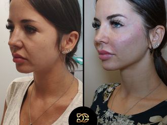Aumento pómulos antes y después - 860824