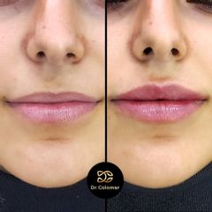 Aumento labios - Dr. Daniel Colomer