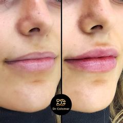 Aumento labios - Dr. Daniel Colomer
