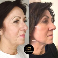 Rellenos faciales - Dr. Daniel Colomer