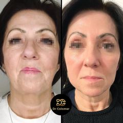 Rellenos faciales - Dr. Daniel Colomer