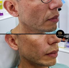 Ácido Hialurónico - Dr. Daniel Colomer
