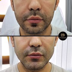 Aumento de mentón - Dr. Daniel Colomer