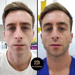 Aumento labios - Dr. Daniel Colomer