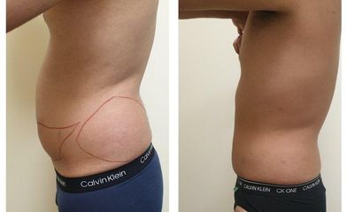 Mesoterapia - Sapphira Prive Retiro