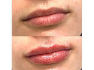 Aumento de labios