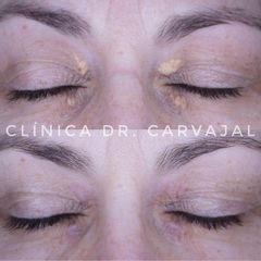 Xantelasmas - Clínica Dr. Carvajal