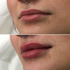 Aumento de labios - Clínica Dr. Carvajal
