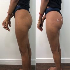 Aumento de glúteos - Clínica Dr. Carvajal