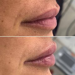 Aumento de labios - Clínica Dr. Carvajal