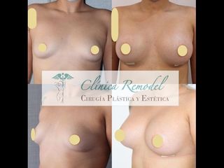Aumento de pecho - Dra. Estefanía Poza Guedes
