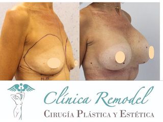 Aumento de pecho - Dra. Estefanía Poza Guedes