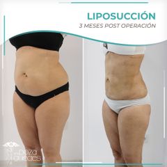 Liposucción - Dra. Estefanía Poza Guedes