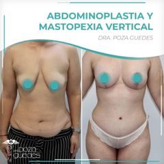 Abdominoplastia + Mastopexia - Dra. Estefanía Poza Guedes
