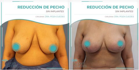 Reducción de senos - Dra. Estefanía Poza Guedes