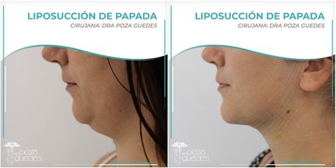 Liposucción de papada - Dra. Estefanía Poza Guedes