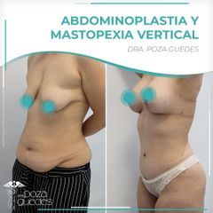 Abdominoplastia + Mastopexia - Dra. Estefanía Poza Guedes