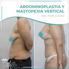 Abdominoplastia + Mastopexia - Dra. Estefanía Poza Guedes