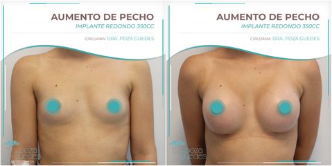 Aumento de pecho - Dra. Estefanía Poza Guedes