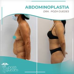 Abdominoplastia - Dra. Estefanía Poza Guedes
