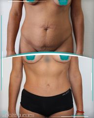 Abdominoplastia - Dra. Estefanía Poza Guedes