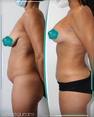 Abdominoplastia - Dra. Estefanía Poza Guedes