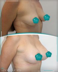 Mastopexia - Dra. Estefanía Poza Guedes