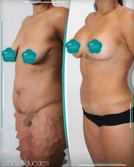 Abdominoplastia - Dra. Estefanía Poza Guedes