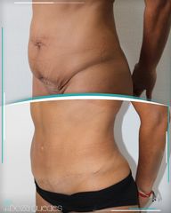 Abdominoplastia - Dra. Estefanía Poza Guedes