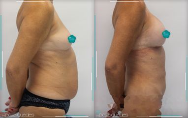 Abdominoplastia - Dra. Estefanía Poza Guedes