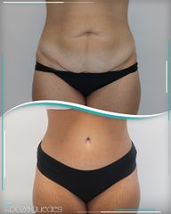 Abdominoplastia - Dra. Estefanía Poza Guedes