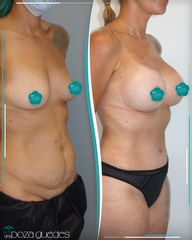 Lipoescultura - Dra. Estefanía Poza Guedes